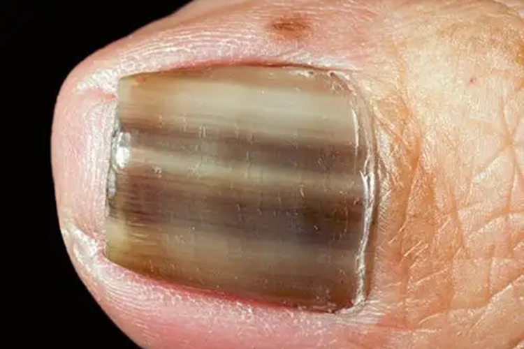 甲母痣指甲棕色线图