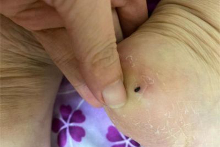 交界痣脚后跟黑斑图 交界痣脚后跟黑斑图