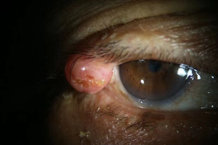 睑板腺癌眼睑肉赘图