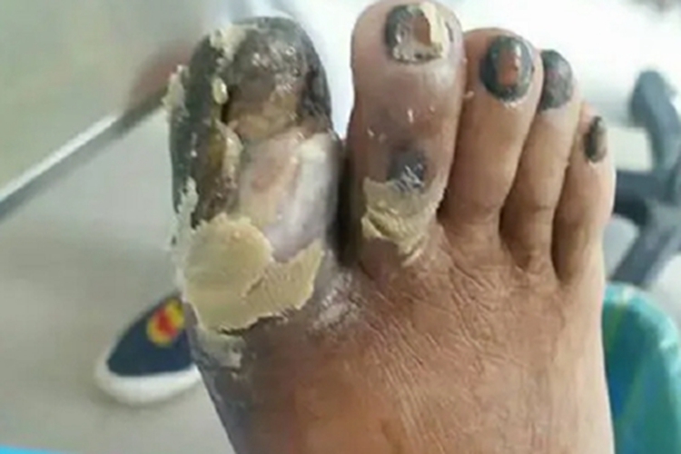 抗磷脂综合征脱皮图