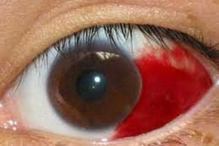 慢性高血压视网膜病变血管破裂图 慢性高血压视网膜病变血管破裂图