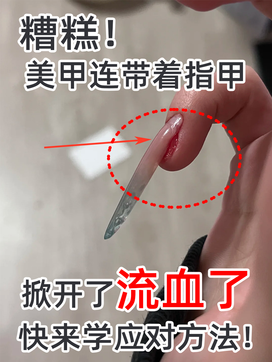 糟糕!美甲连带着指甲掀开了流血了,快来学应对方法!