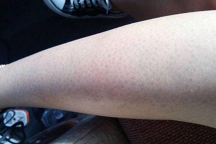 毛囊性鱼鳞病小腿斑图