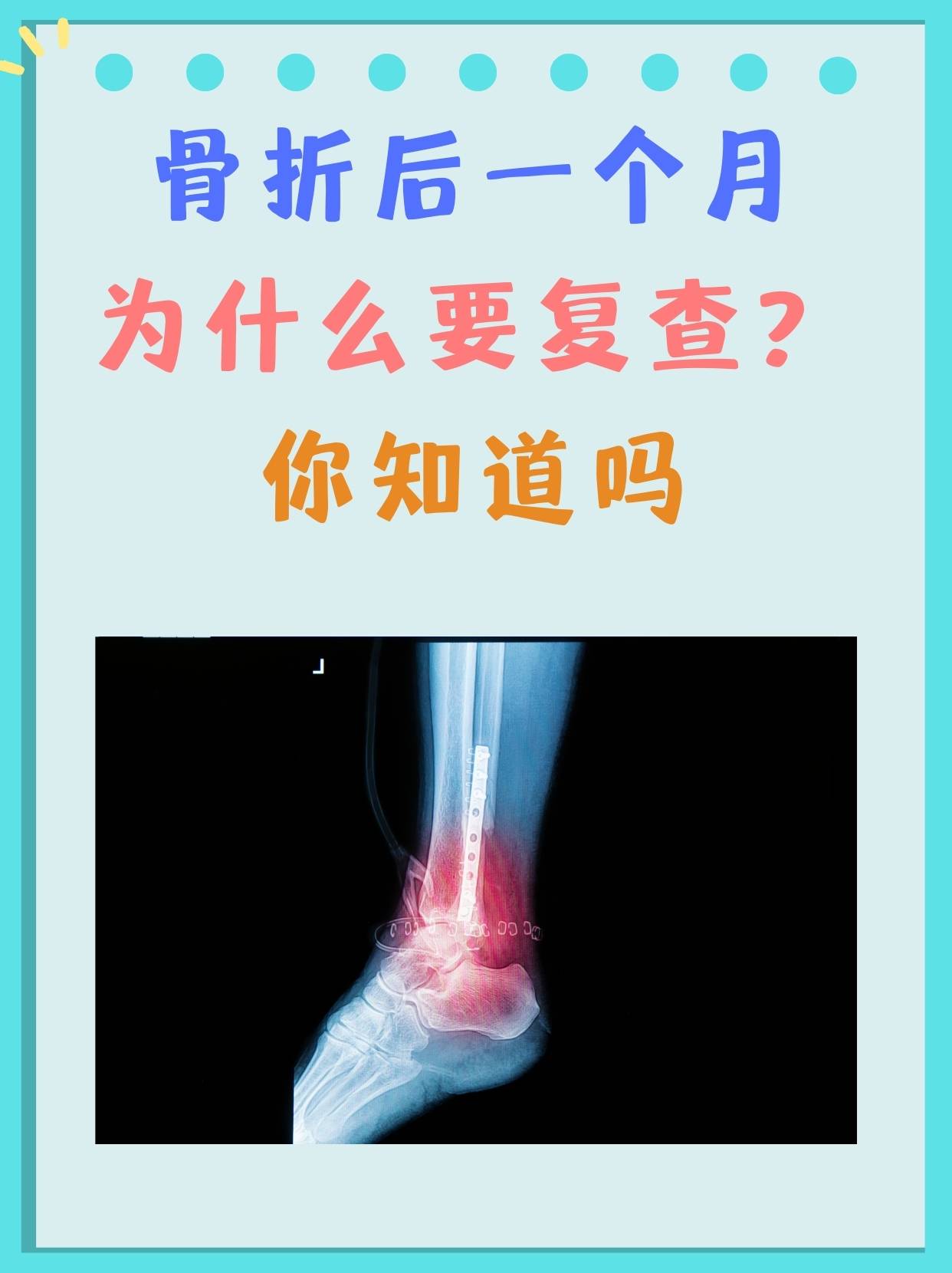 骨折后一个月为什么要复查？你知道吗