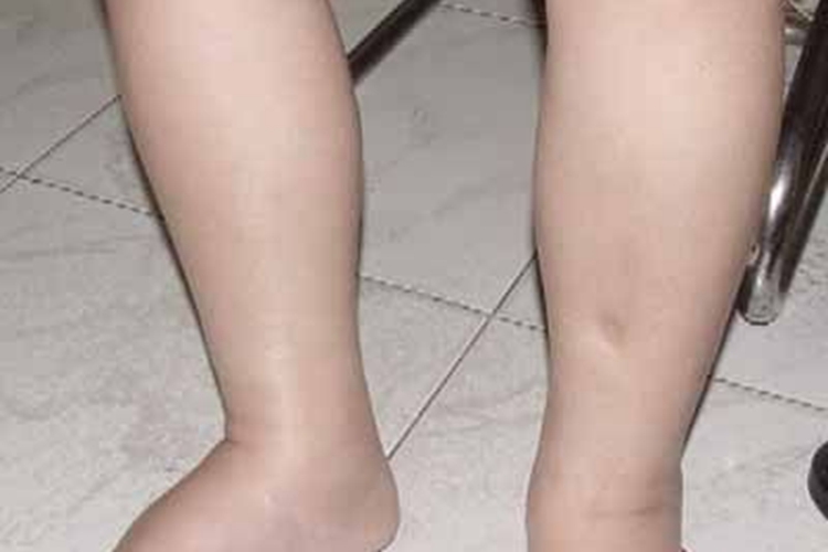 维生素B1缺乏症小腿症状图