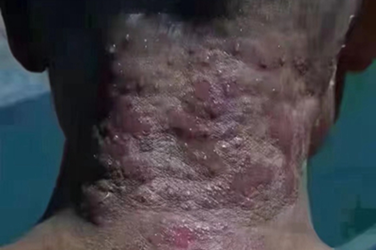 泛发性脓疱型银屑病后颈症状图 泛发性脓疱型银屑病后颈症状图