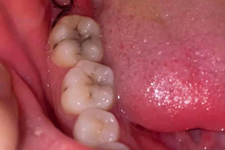 浅龋牙齿窝沟症状图