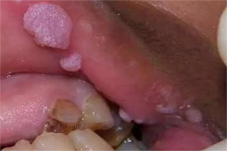 尖锐湿疣上嘴唇疣体图 尖锐湿疣上嘴唇疣体图