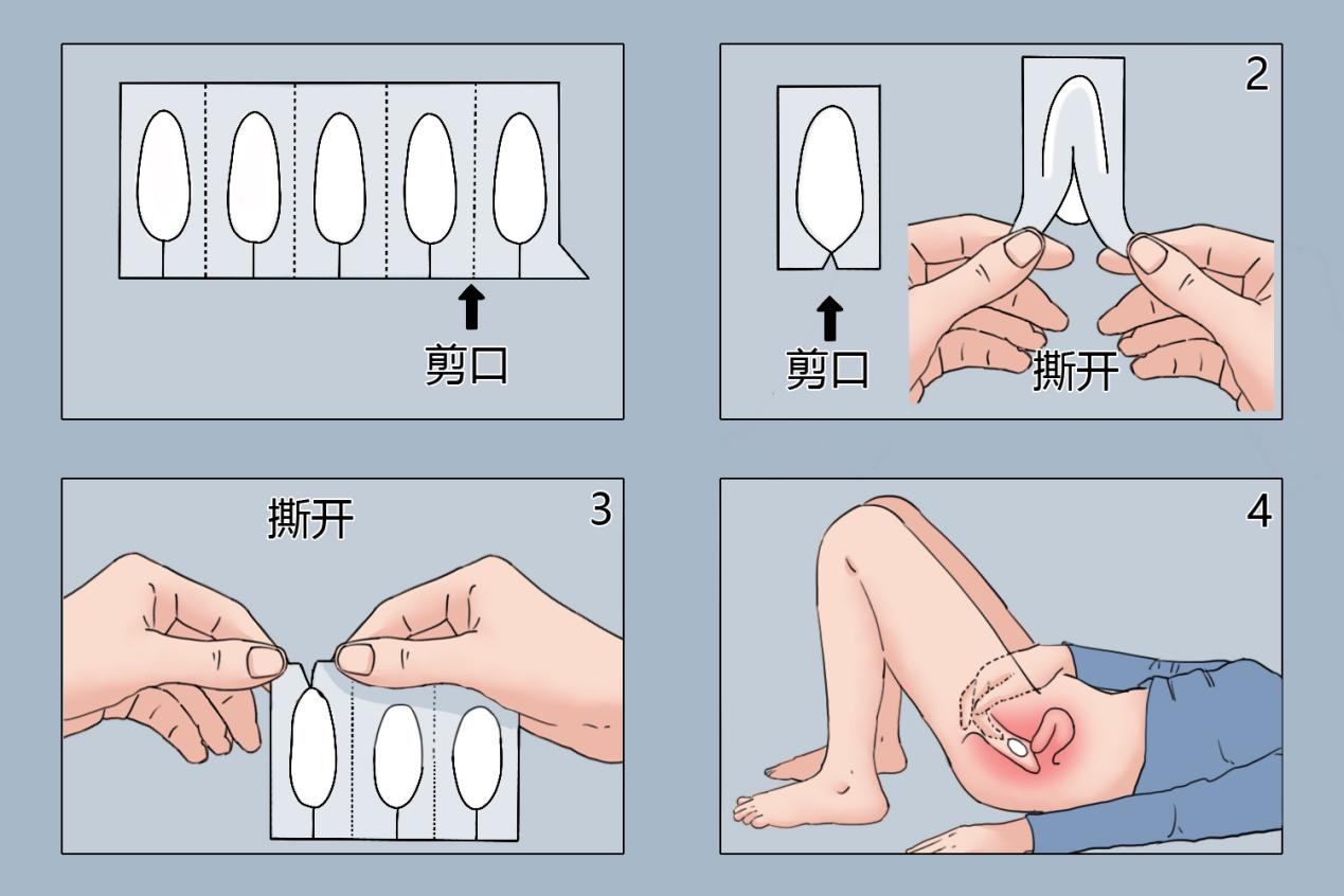 克霉唑栓正确放置图片图片