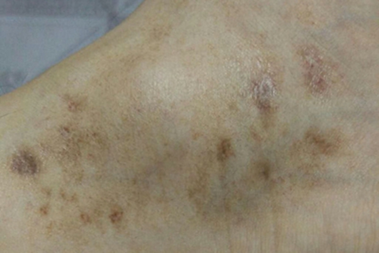 青斑性血管病脚踝长斑图 青斑性血管病脚踝长斑图