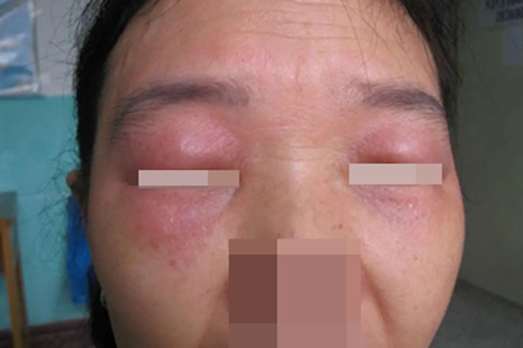 吃巴沙鱼过敏眼周水肿图 吃巴沙鱼过敏眼周水肿图