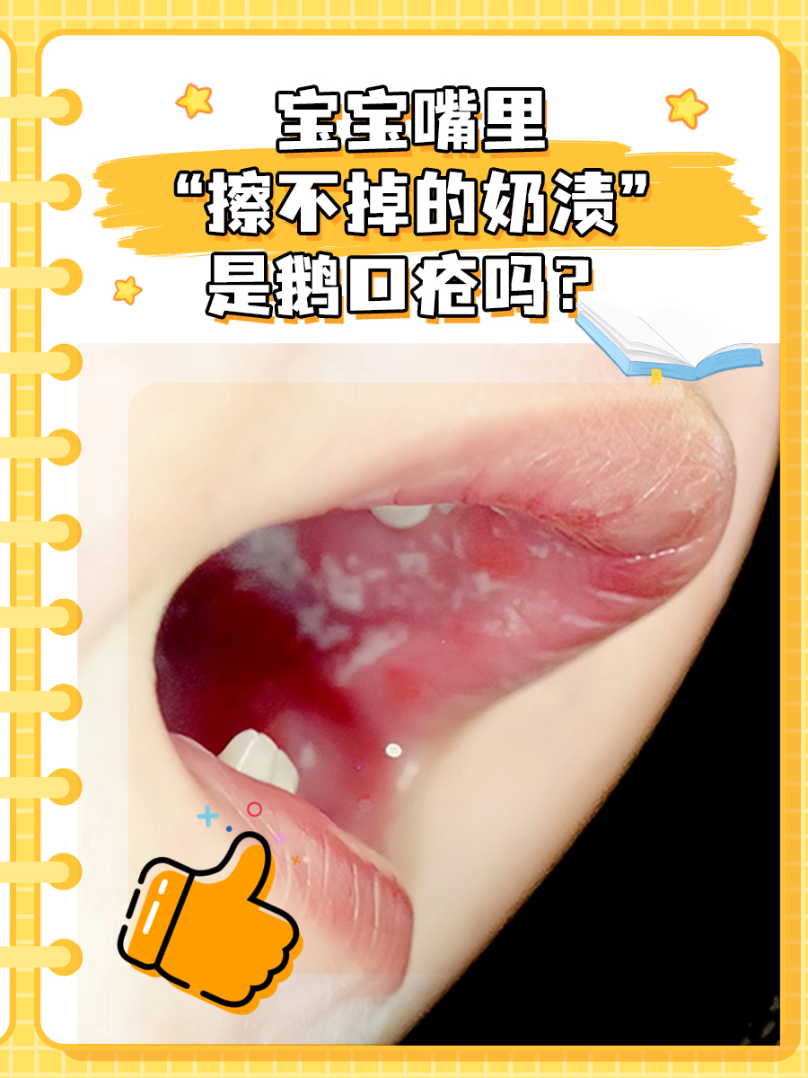 宝妈进！宝宝嘴里“擦不掉的奶渍”是鹅口疮吗？