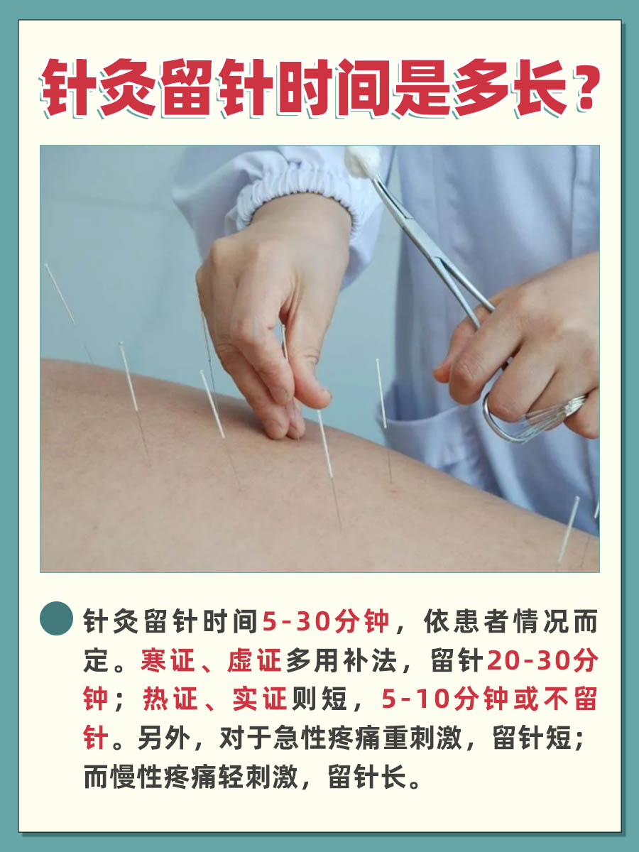 时间指南—针灸留针一般留多长时间