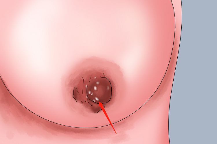 乳头结痂图 乳头结痂图