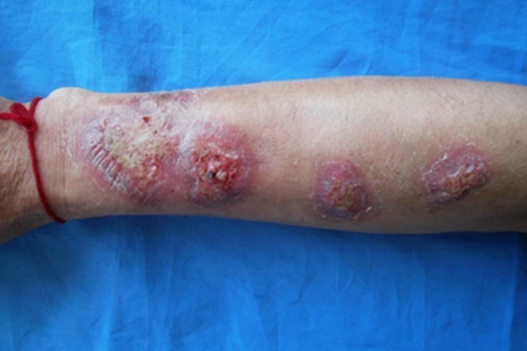 诺卡菌病糜烂图