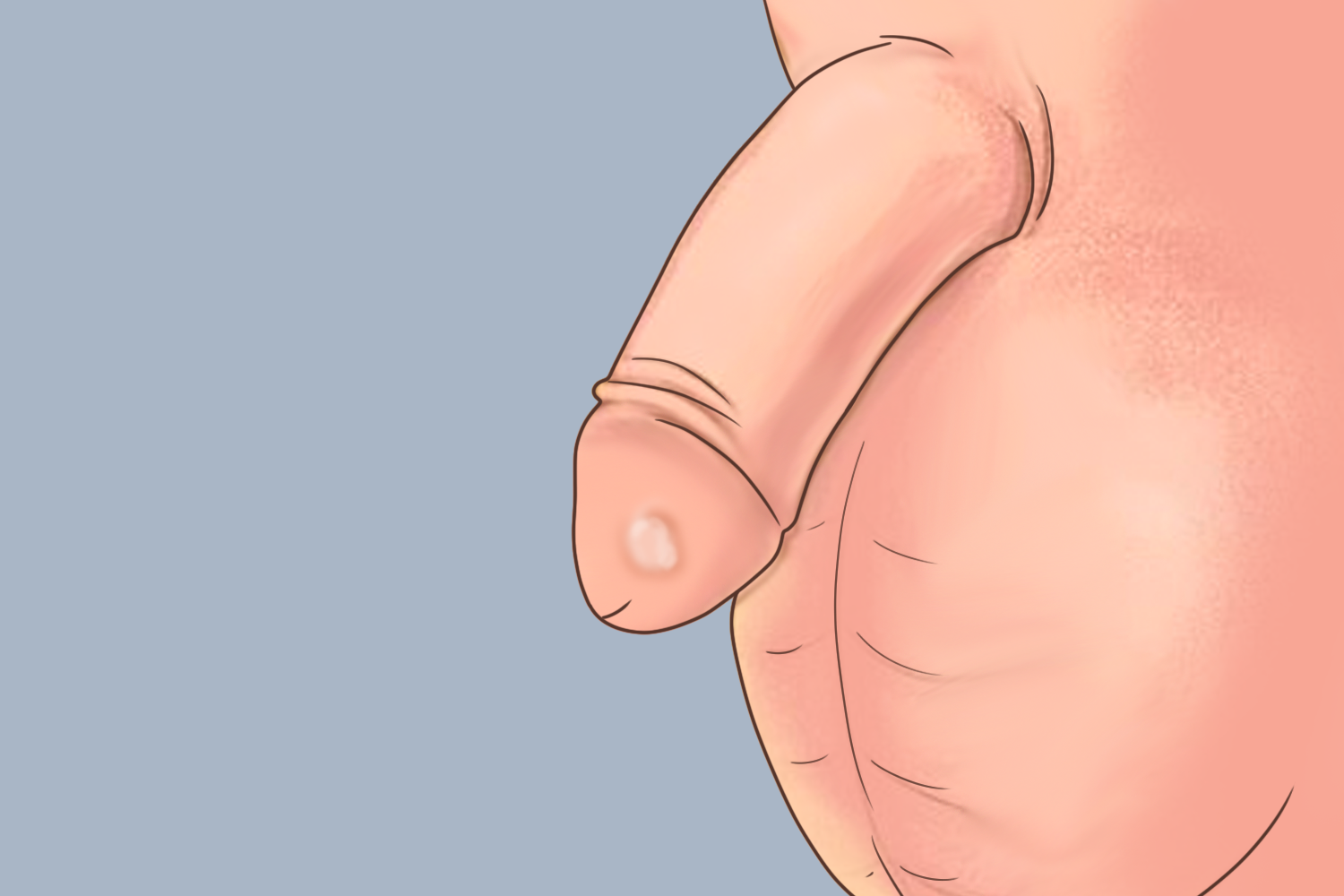 男性阴茎硬化萎缩性苔藓图