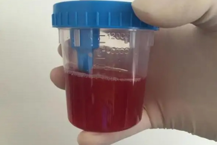 肾不好尿液颜色改变图