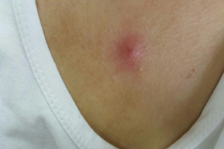 刺毛虫皮炎胸部症状图