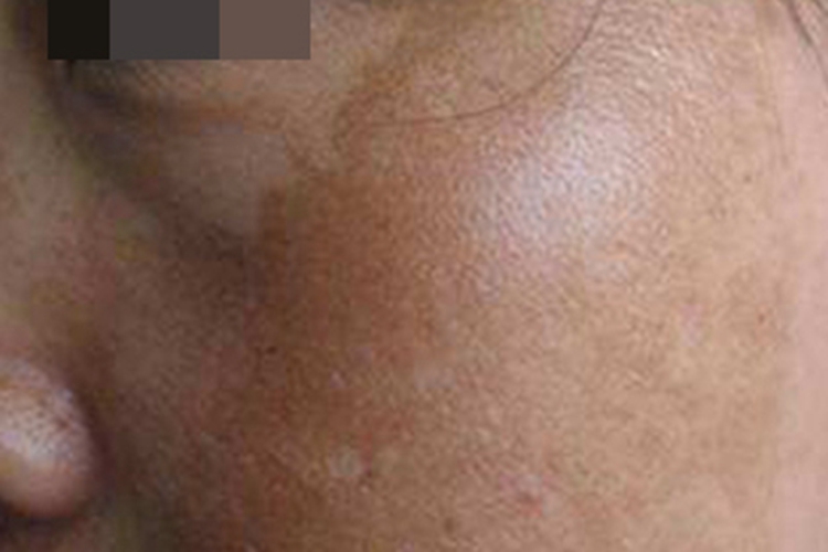 黄褐斑脸上深褐色斑图