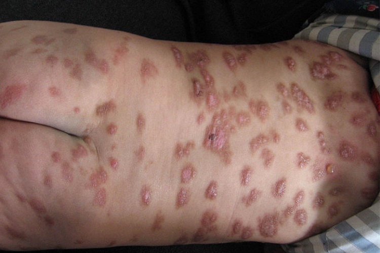 皮肤肥大细胞增生病背部红斑图