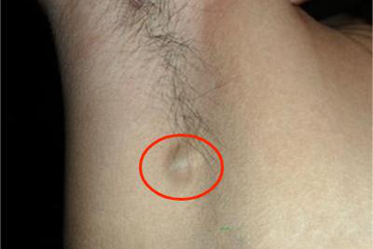 男性乳头状汗腺腺瘤腋窝包块图