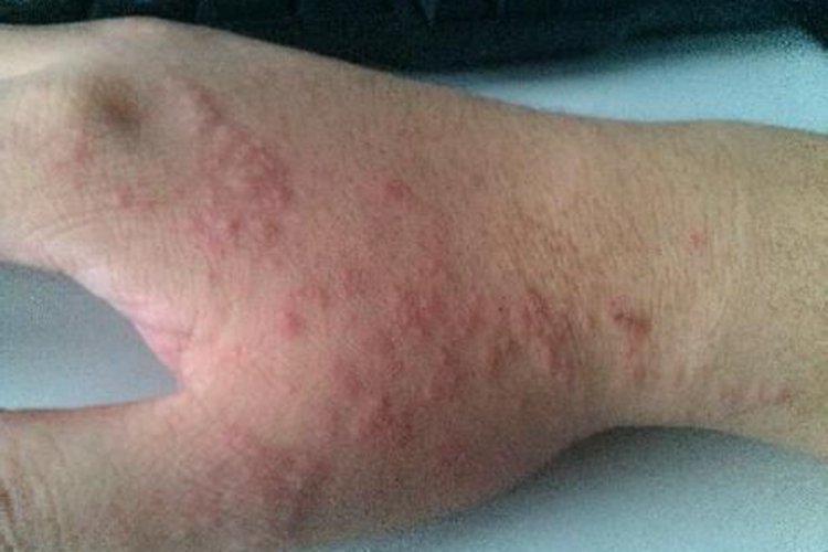 氧化锌过敏丘疹图