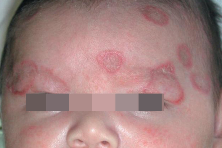 亚急性皮肤型红斑狼疮环形红斑图