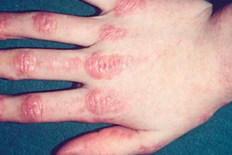 血管萎缩性皮肤异色病手部红斑图 血管萎缩性皮肤异色病手部红斑图