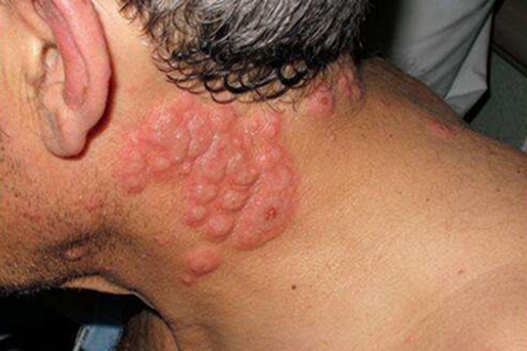 急性发热性嗜中性皮病颈部症状图