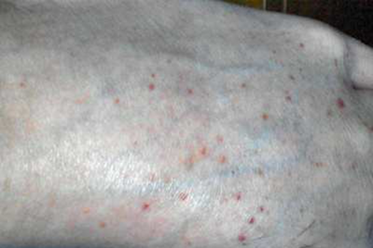 色素性紫癜性皮疹脚背症状图 色素性紫癜性皮疹脚背症状图