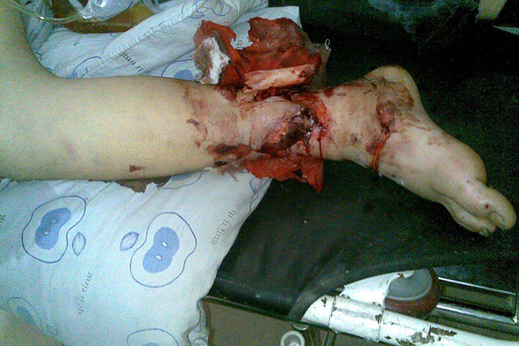 儿童胫腓骨干骨折图