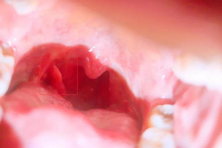 扁桃体术后肉芽组织增生图