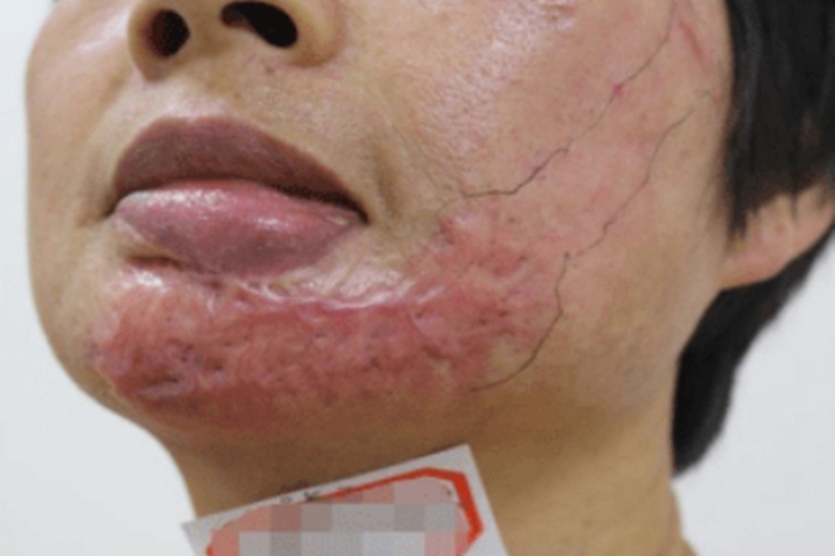 增生性瘢痕面部瘢痕图