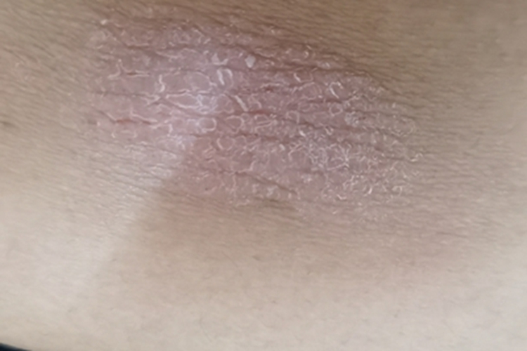 局限性神经性皮炎腹部症状图 局限性神经性皮炎腹部症状图