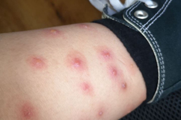 跳蚤叮咬小腿水疱图 跳蚤叮咬小腿水疱图