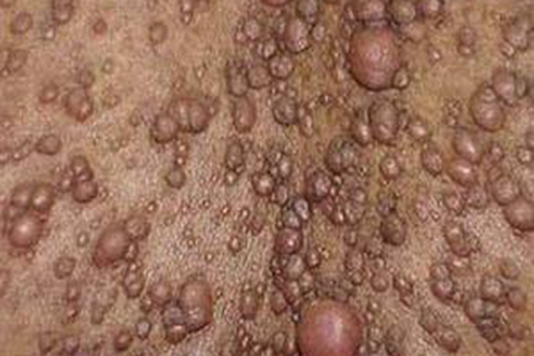 丛状神经纤维瘤图 丛状神经纤维瘤图