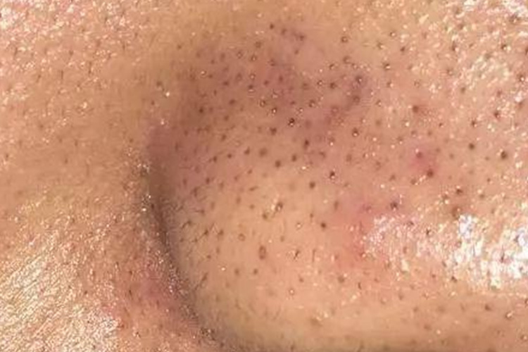 黑头粉刺鼻部皮损图 黑头粉刺鼻部皮损图