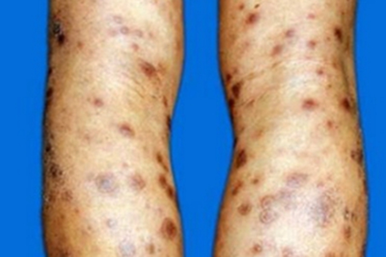 男性扁平湿疣小腿症状图