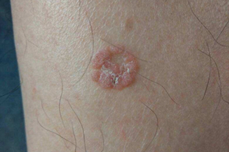 寻常疣样职业性疣赘小腿症状图