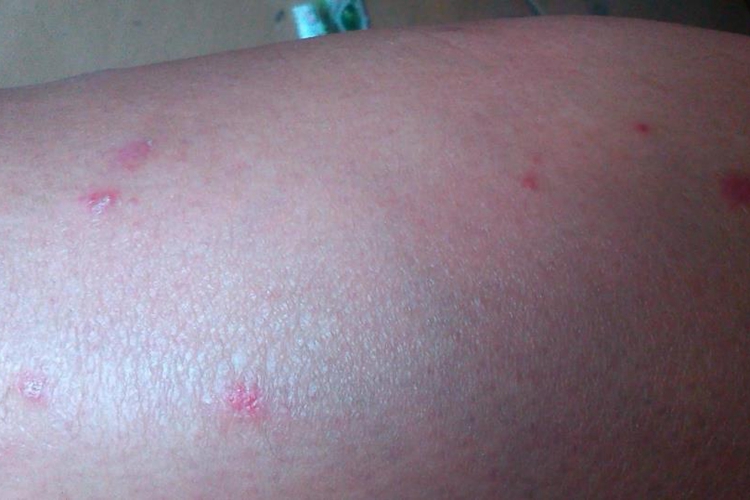 点滴状副银屑病图 点滴状副银屑病图