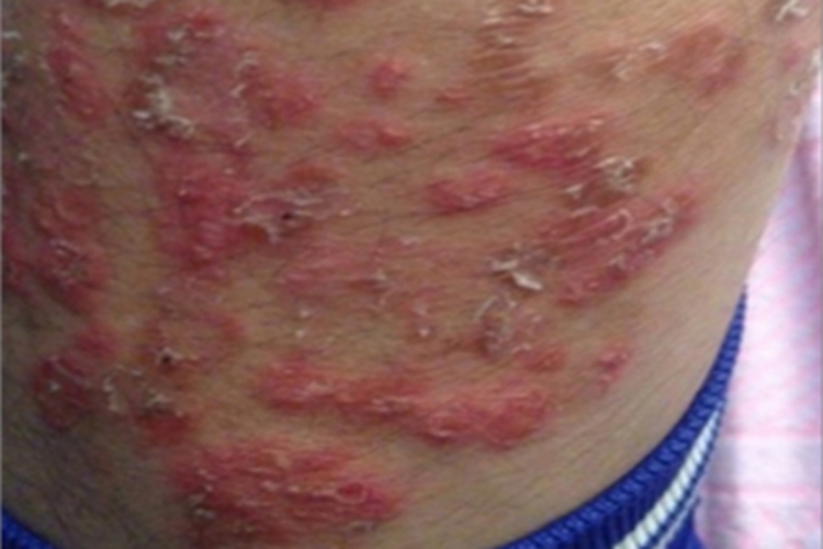 男性三期梅毒长大红疙瘩图
