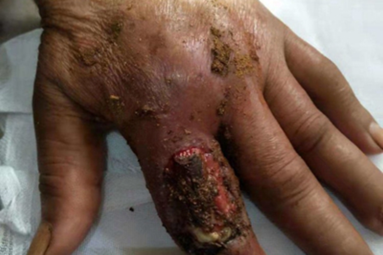 毒蛇咬伤食指溃疡流黄脓图