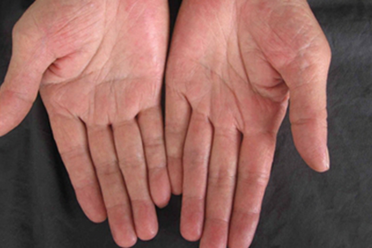 红斑性肢痛症手掌症状图