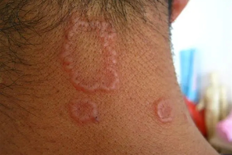 颈部环状肉芽肿图