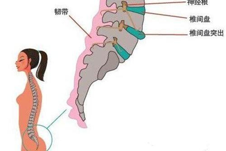 腰椎间盘突出图