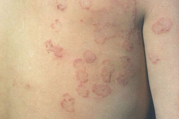 体癣前胸红印图