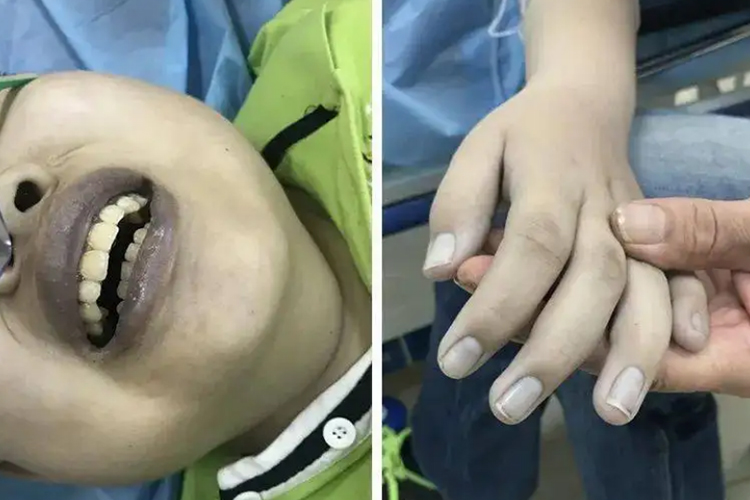 头孢过敏口唇、甲床发绀图