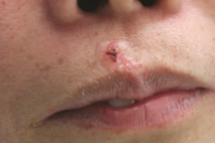 硬化性汗腺导管癌小疙瘩图