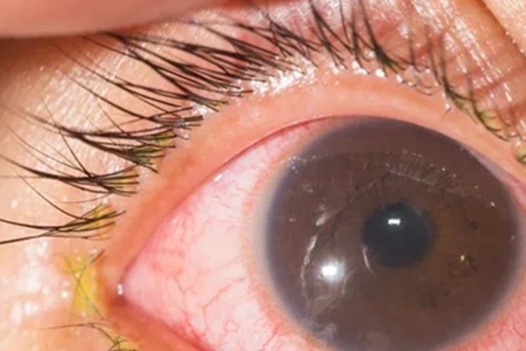 细菌性结膜炎分泌物图