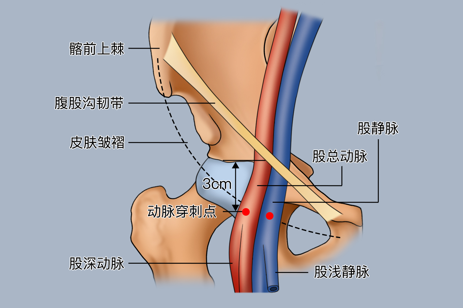 左右股动脉退热贴图片图片